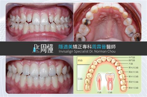 牙齒小顆的人|牙齒太小怎麼辦？除了矯正，Dcard還推薦這些治療方。